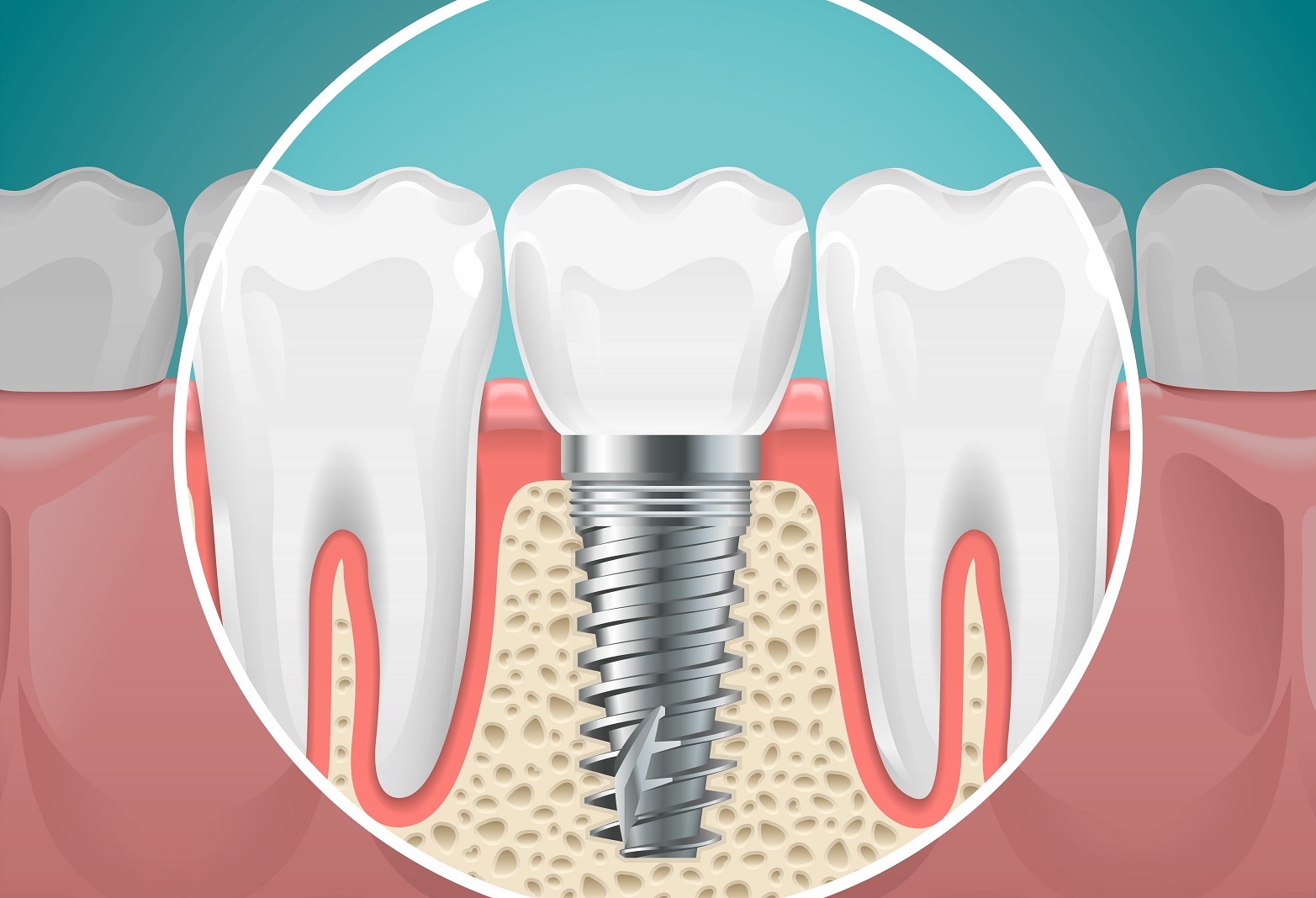 Impianti dentali