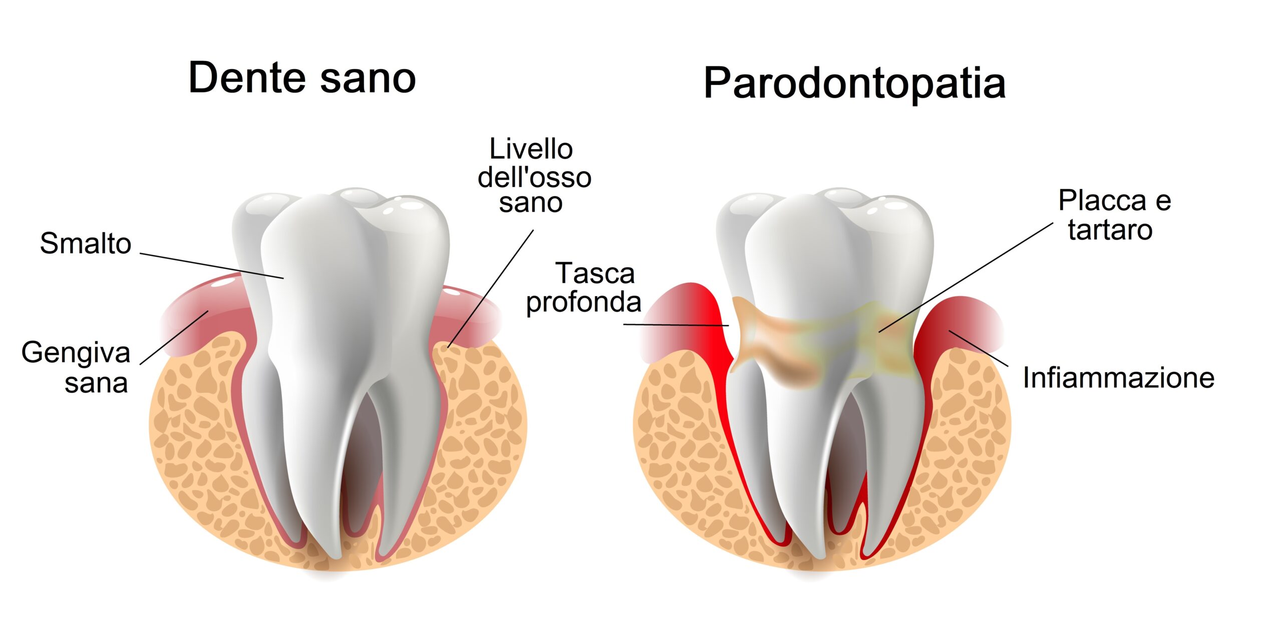 parodontite