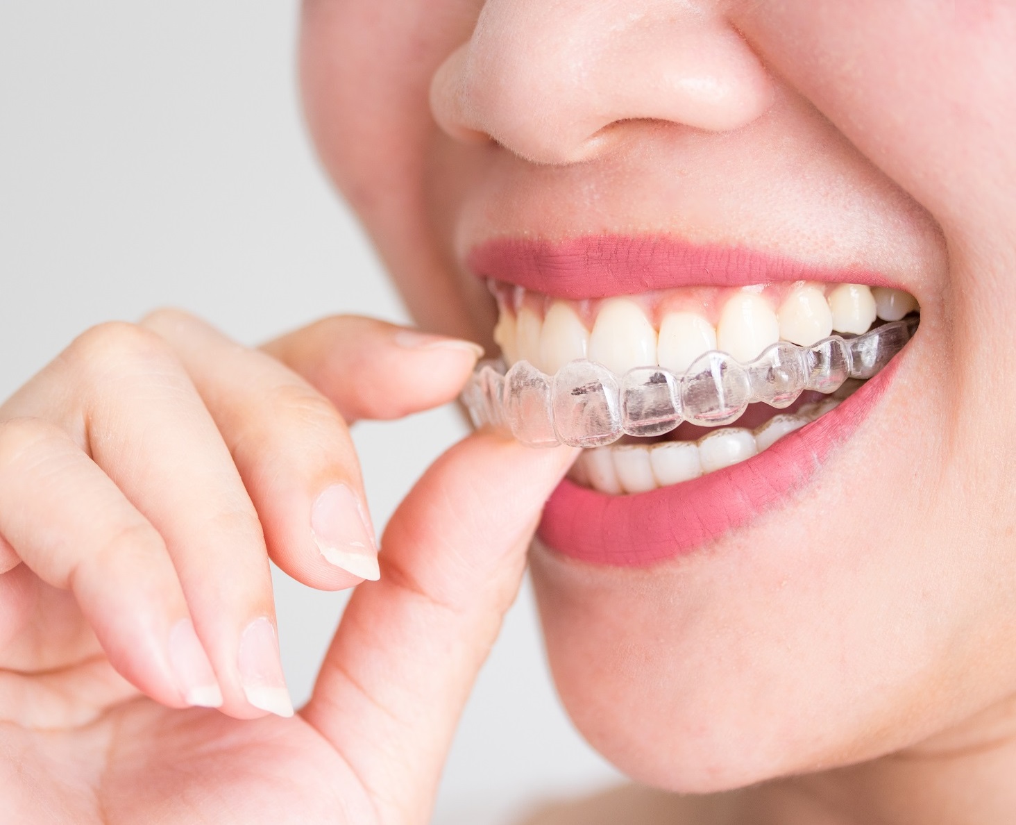 Invisalign