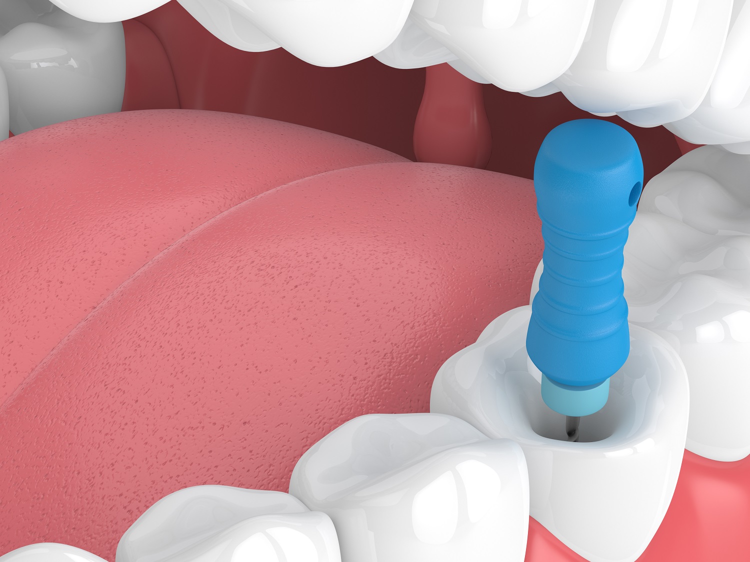 cura endodontica