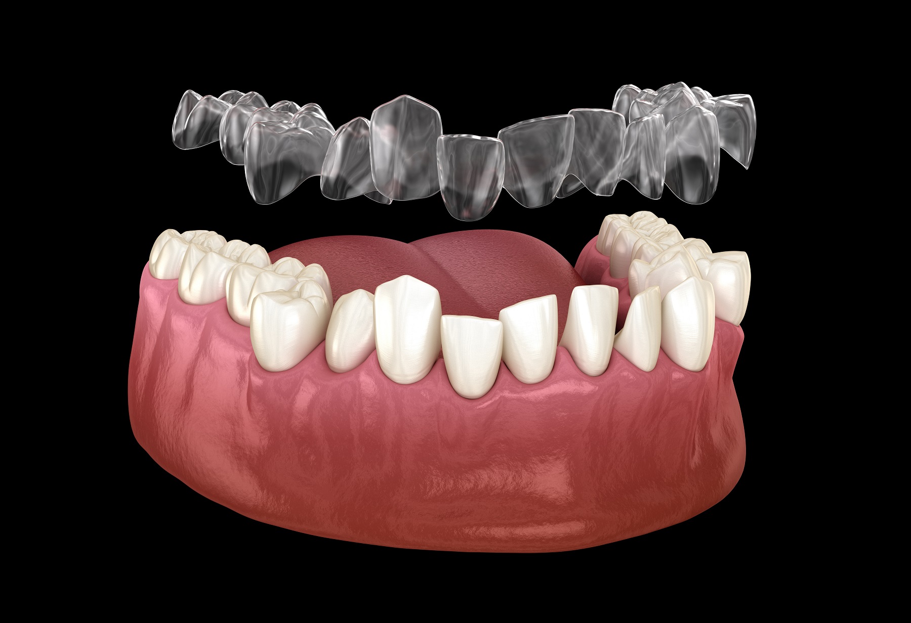 ortodonzia trasparente