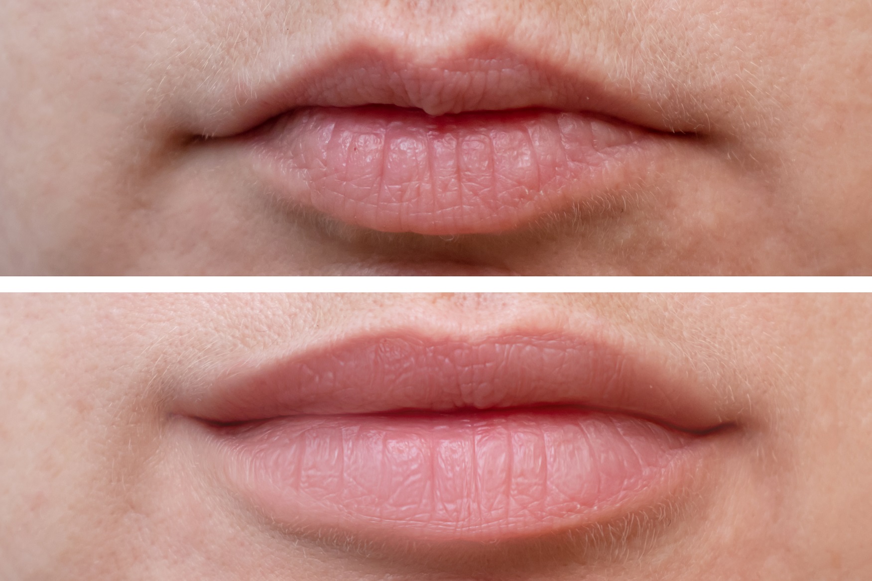 filler labbra